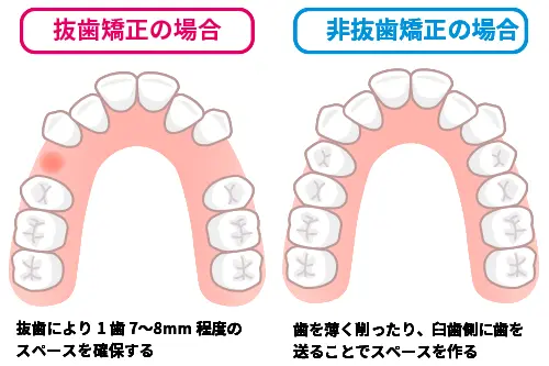 非抜歯矯正でスペースを確保する治療方針のイメージ