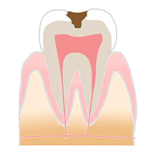 C2の虫歯