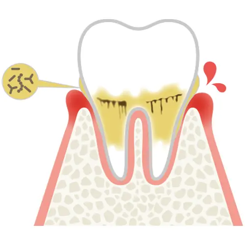 軽度歯周病