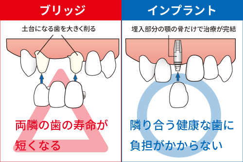 周囲の歯を削らずに済むインプラントのイメージ