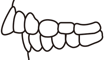 上顎前突の線画