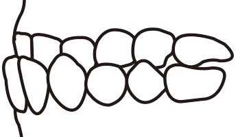 下顎前突の線画