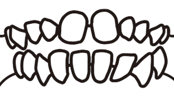 空隙歯列の線画