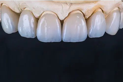 セラミック治療の模型