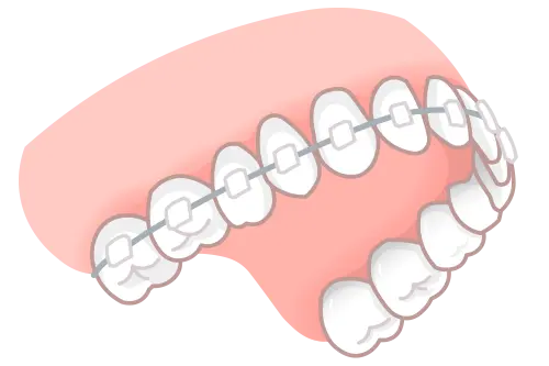 ワイヤー矯正イラスト