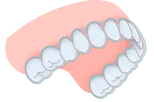 マウスピース矯正イラスト