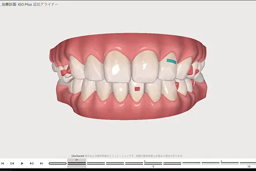 矯正治療計画の説明