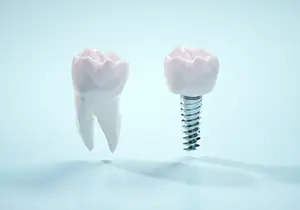 インプラントと天然歯