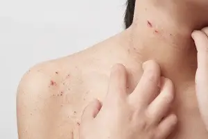 金属アレルギーによる皮膚疾患