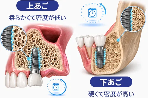上あごと下あごの骨の密度の違いを示すイメージ