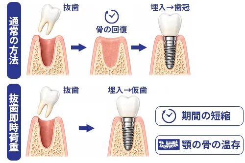 即時荷重インプラントの図解