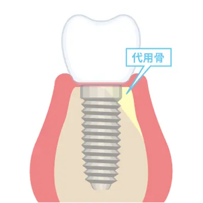 GBRの手法イメージ