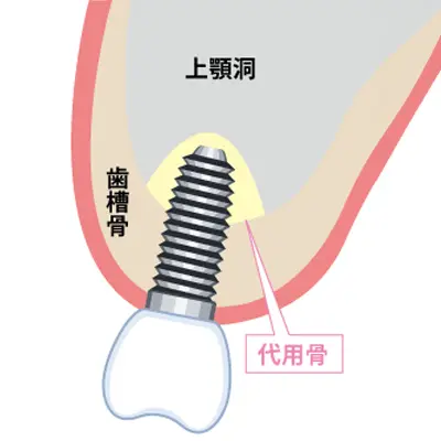 ソケットリフトの手法イメージ