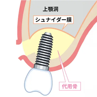 サイナスリフトの手法イメージ