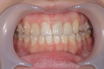 八重歯治療後の口腔内写真正面観