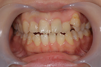 八重歯の口腔内写真正面観