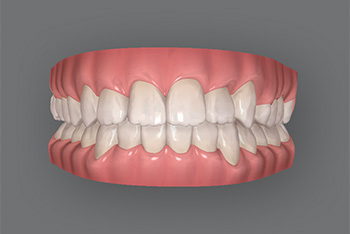 八重歯の光学式口腔内スキャン画像による治療後シミュレーション画像