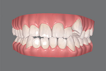 八重歯の光学式口腔内スキャン画像