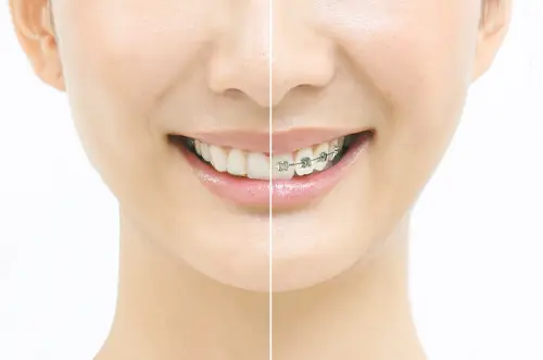 マウスピース矯正とワイヤー矯正の比較