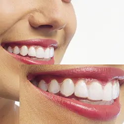 マウスピース矯正装着時の口元