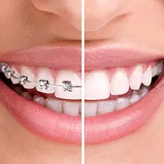 表側矯正と裏側矯正の見え方の違い