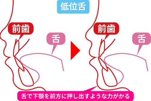 口呼吸や舌の位置が顎に影響するイメージ