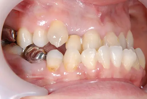 口呼吸による虫歯・歯周病リスクのイメージ