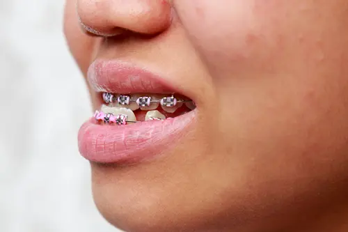 矯正装置で歯並びを改善するイメージ