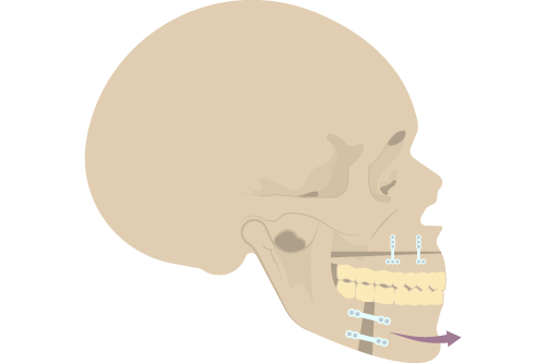 骨格性の受け口に対する外科矯正のイメージ