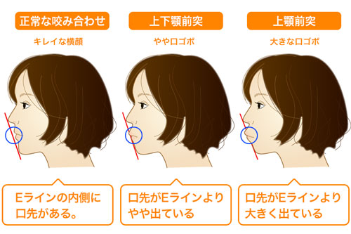 口ゴボ くちごぼ の治し方 明石市の歯医者 明石アップル歯科