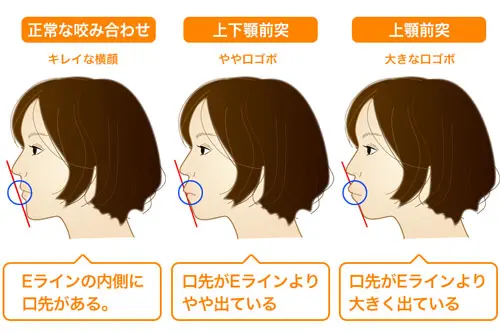 きれいな横顔・やや口ゴボの横顔・口ゴボの横顔の比較