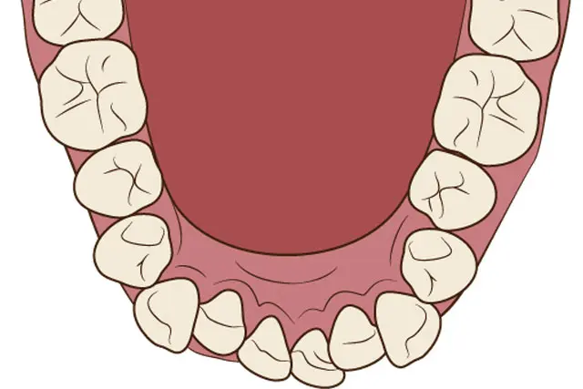 歯が並ぶスペースがない歯列弓