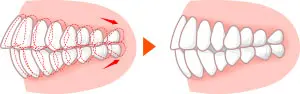 歯を後ろに送る場合の歯の動き