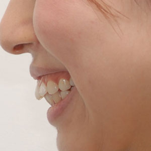 なぜ 歯を矯正したらブサイクになった 明石市の歯医者 明石アップル歯科