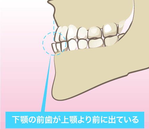 受け口の骨格