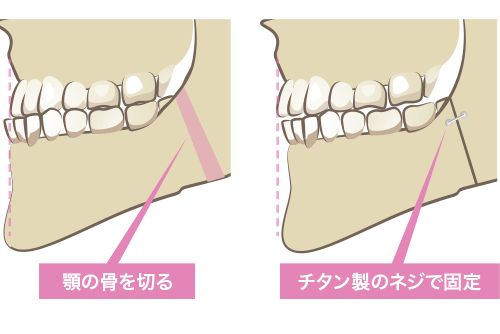 外科矯正