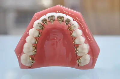 裏側矯正の模型