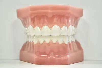 マウスピース矯正の模型