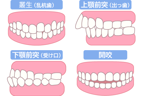 叢生・上顎前突・下顎前突・開咬のイラスト