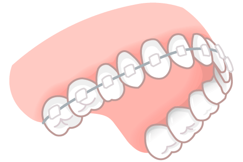表側矯正イラスト