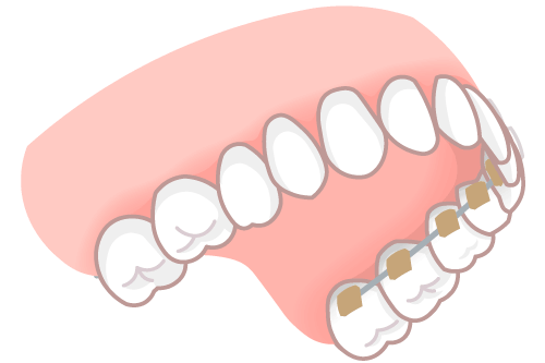 裏側矯正イラスト