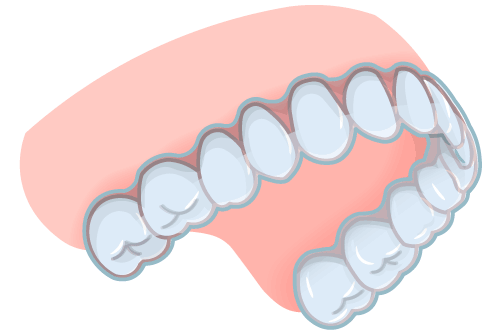 マウスピース矯正イラスト