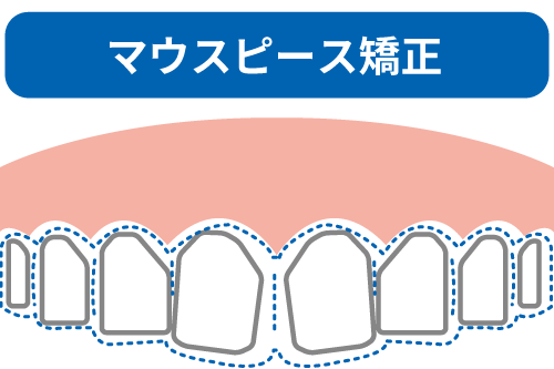 マウスピース矯正のイメージイラスト
