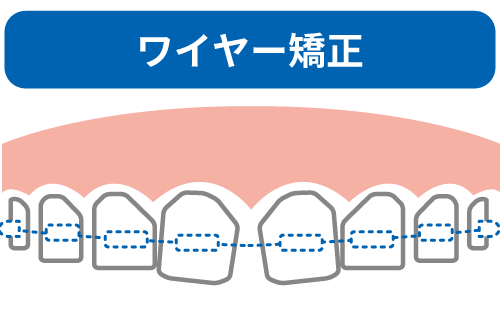 ワイヤー矯正のイメージイラスト