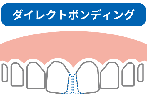 ダイレクトボンディングのイメージイラスト