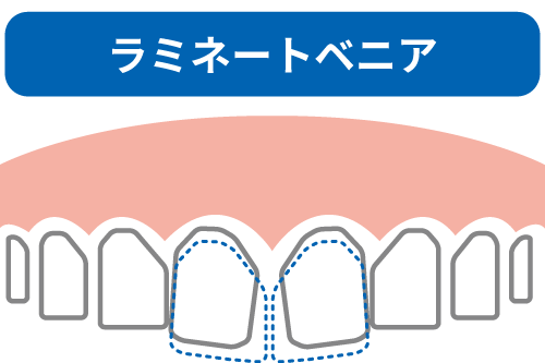 ラミネートベニアのイメージイラスト