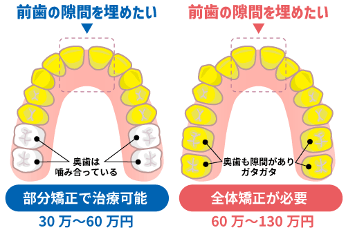 部分矯正と全体矯正の範囲の違いを比較するイメージ