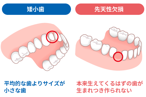 矮小歯や先天性欠如によるすきっ歯の解説イメージ