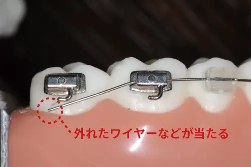 外れたワイヤーが当たる