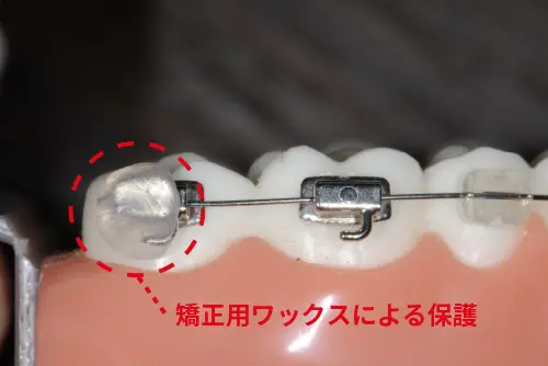 口元のコンプレックスに悩む人